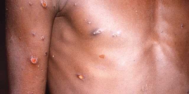 An image created during an investigation into an outbreak of monkeypox, which took place in the Democratic Republic of the Congo, 1996 to 1997, shows the arms and torso of a patient with skin lesions due to monkeypox, in this undated image obtained by Reuters on May 18, 2022. 