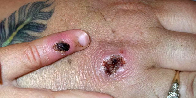In these Centers for Disease Control and Prevention handout graphic, symptoms of one of the first known cases of the monkeypox virus are shown on a patient’s hand June 5, 2003. The CDC said the viral disease monkeypox, thought to be spread by prairie dogs, has been detected in the Americas for the first time with about 20 cases reported in Wisconsin, Illinois, and Indiana. 